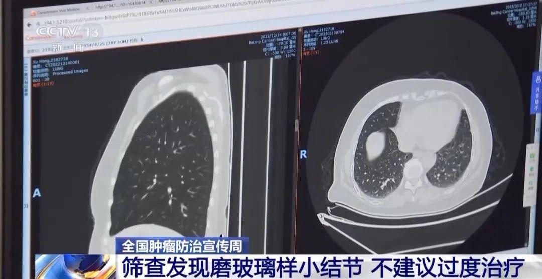 肺癌连续10年全球死亡率居首！早筛早治是关键
