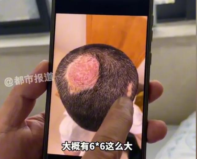 6岁男孩养兔染真菌致脓藓，终身脱发警示家长注意
