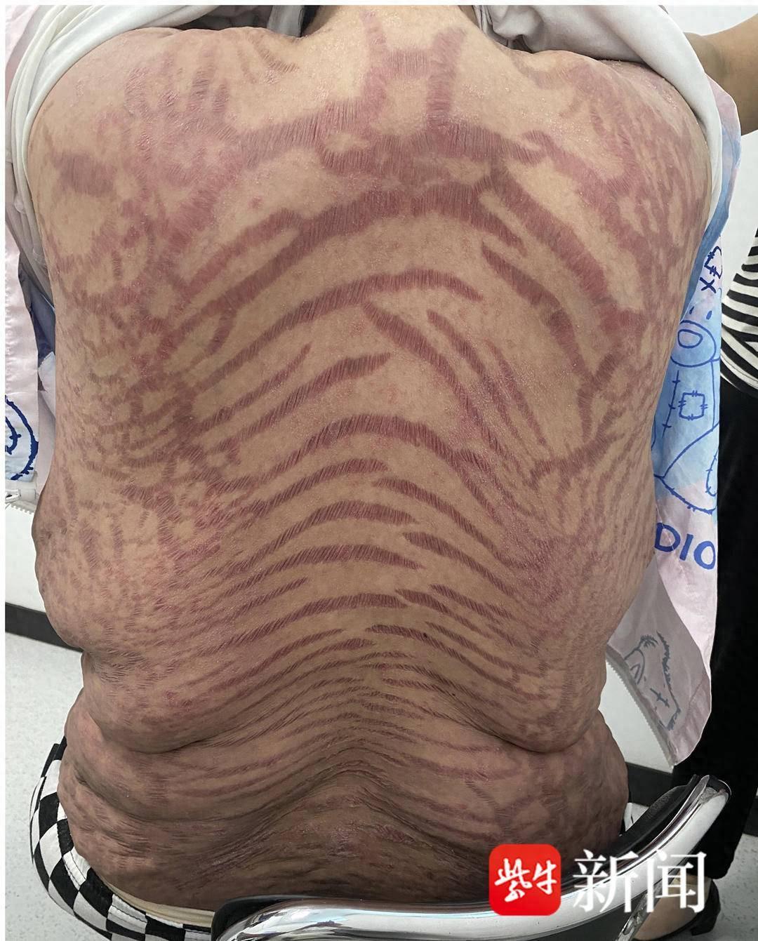 40岁女子滥用网红药膏致全身蛇状纹，医生提醒慎用“神药”