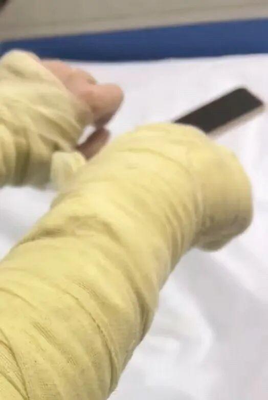 湖南女主播遭伪装包裹炸伤，面部深二度烧伤，警方介入调查