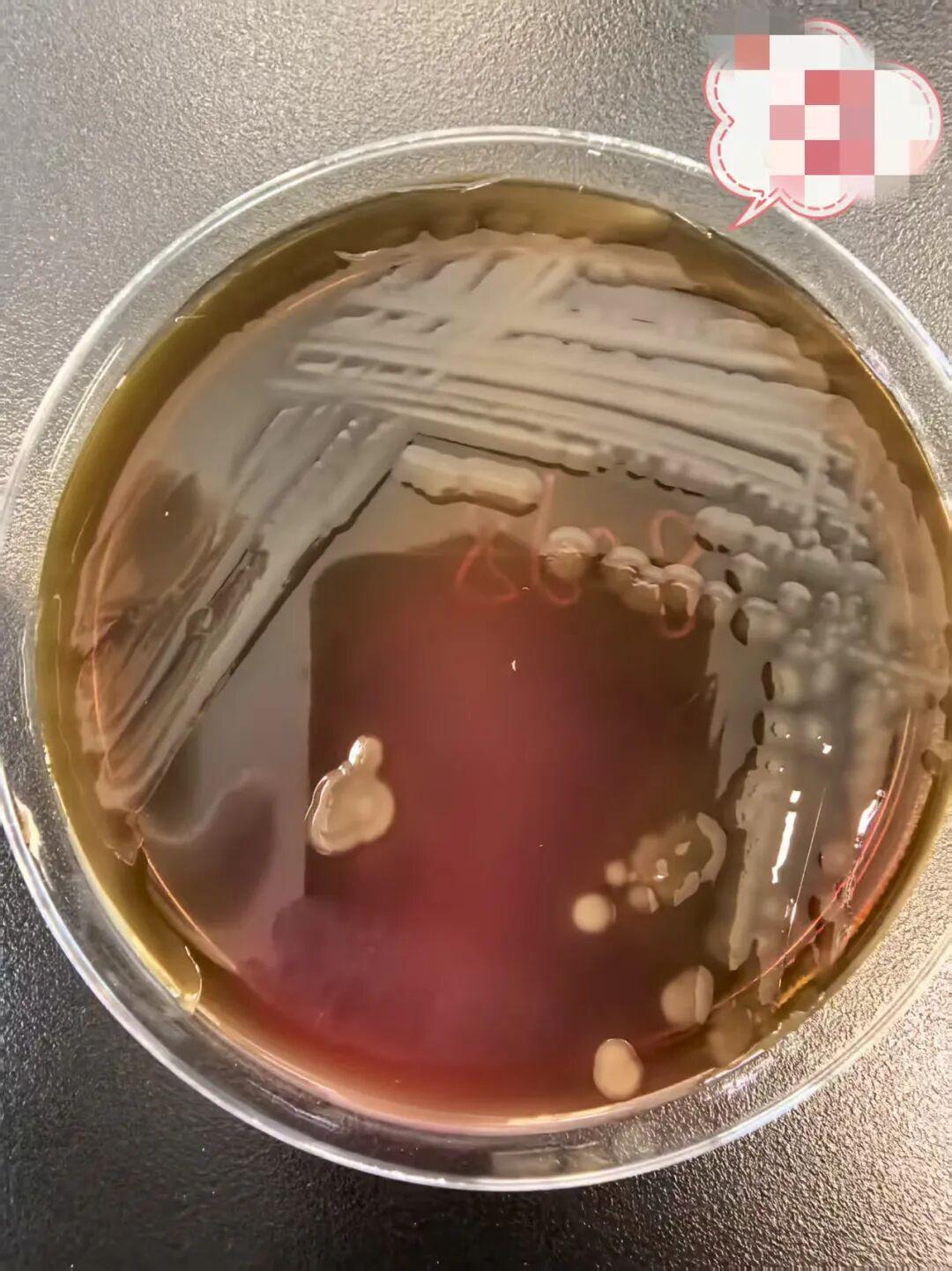 40℃高烧休克险丧命！男子食用未熟海鱼感染创伤弧菌，病死率超50%