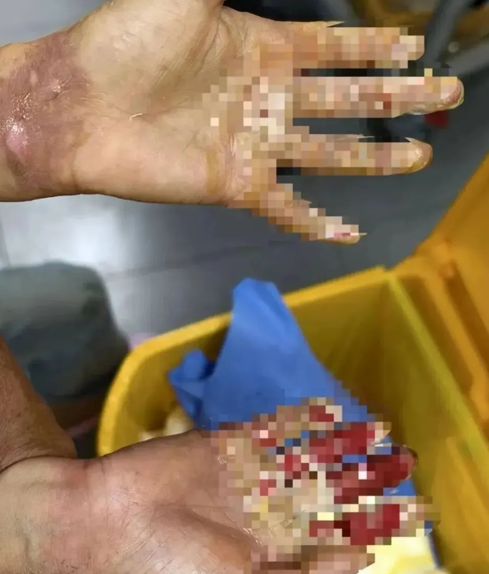 3岁男童意外跌入炭堆致重伤，母亲徒手救子双手严重烧伤