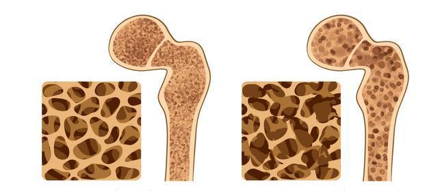 学医后揭秘：提升骨密度最佳运动，竟不是散步游泳