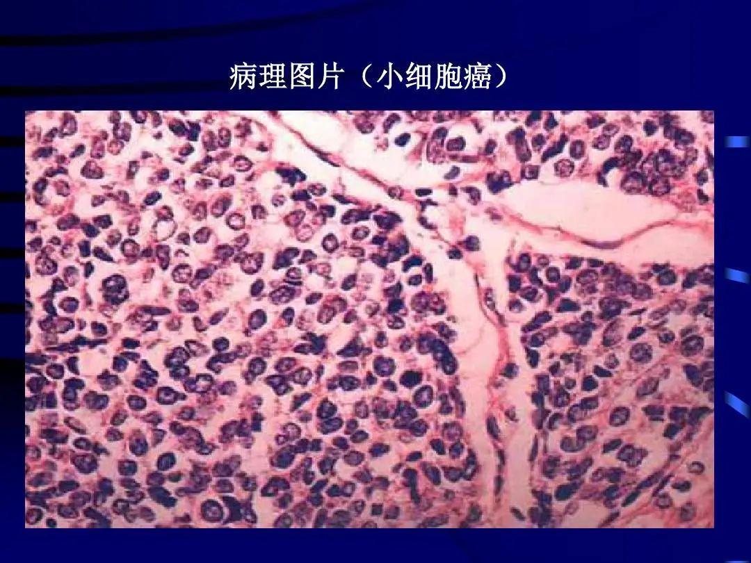 癌症转移速度惊人！早期到全身扩散或仅需3个月，警惕4大扩散信号