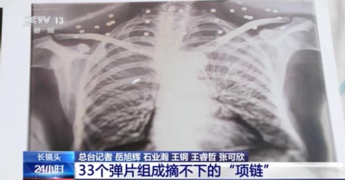 33个弹片嵌入体内 这条摘不下的“项链”成了他的光荣勋章
