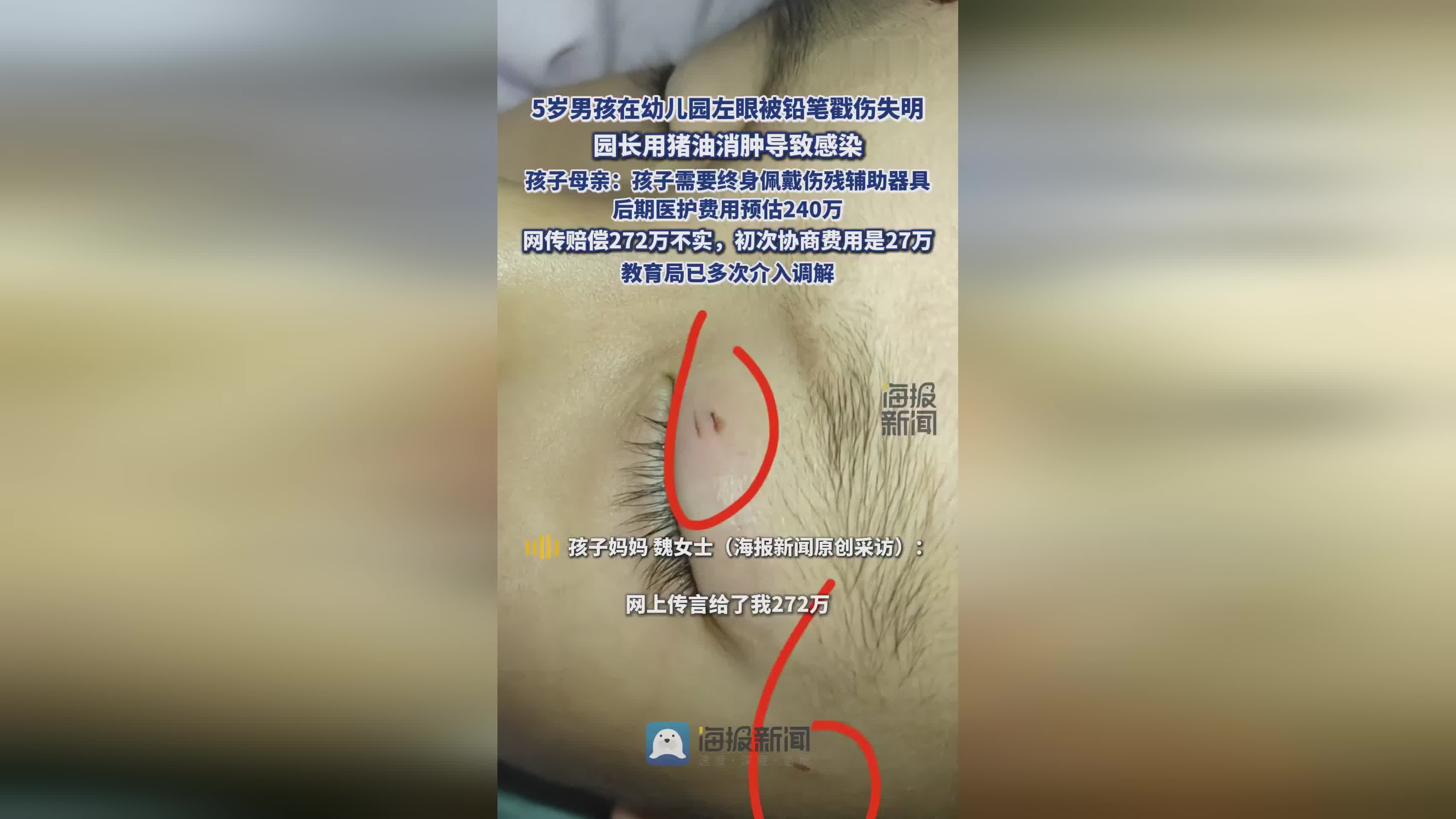 5岁男童幼儿园眼球受伤失明，园长涂猪油处理，家长辟谣272万赔偿