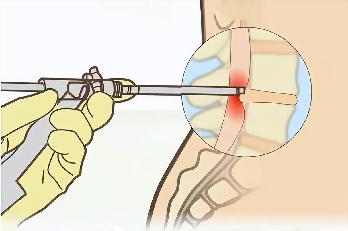 腰突微创手术真相：是否安全？哪些人不能做？