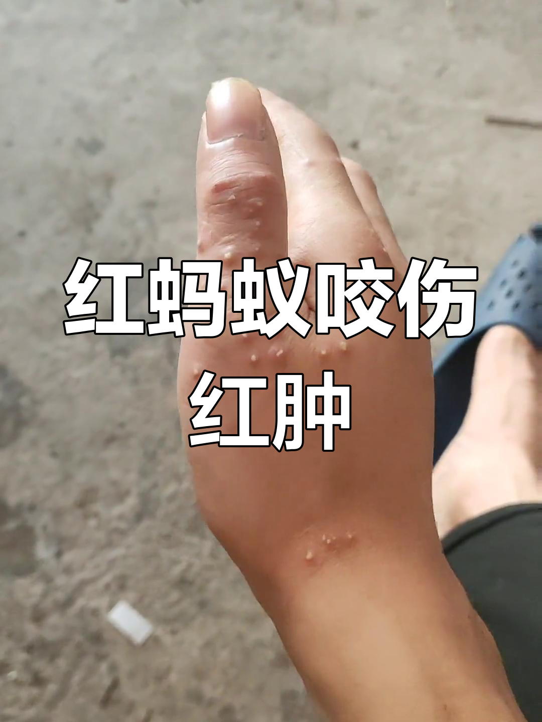 警惕！广西红火蚁咬人事件频发，多人受伤甚至进ICU