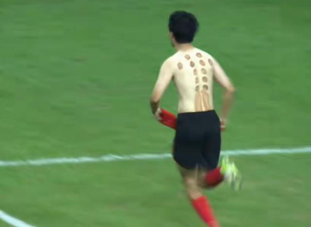 苏超南通球员拔火罐引热议，专家详解适用人群与禁忌部位